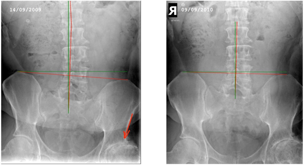 Is It Possible To Reverse Osteoarthritis?