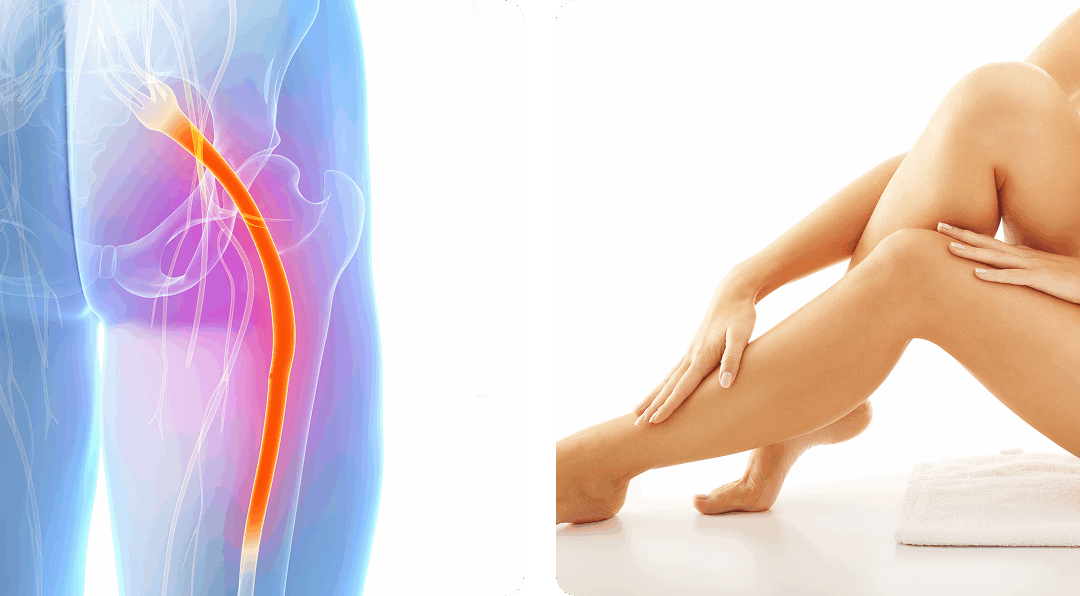Sciatica Solutions: Effective Relief for Nerve Pain