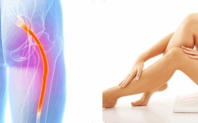 Sciatica Solutions: Effective Relief for Nerve Pain